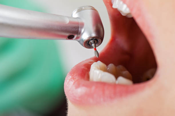Best Emergency Root Canal Treatment in Grandview, IL